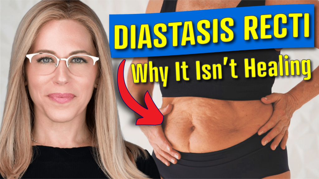 Diastasis recti thumbnail 2